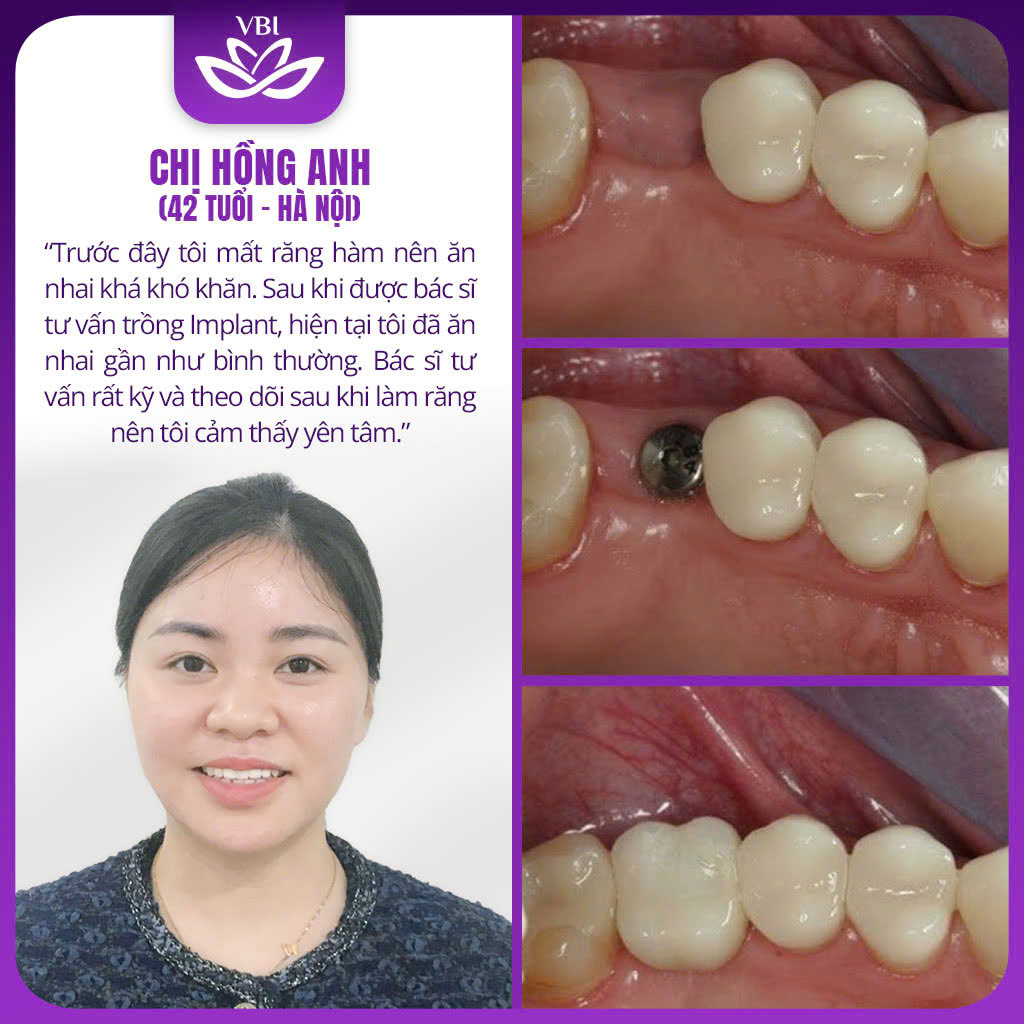 Khách hàng chia sẻ cảm nhận sau khi trồng Implant tại Nha Khoa Việt Bỉ