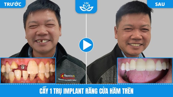 Kết quả trồng răng Implant tại Nha Khoa Việt Bỉ - ca số 2