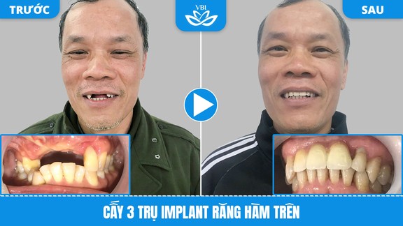 Kết quả trồng răng Implant tại Nha Khoa Việt Bỉ - ca số 3