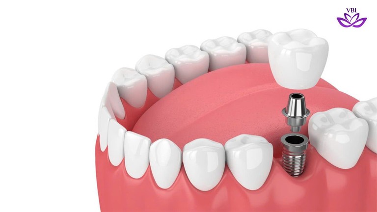 Minh họa cấu tạo trụ Implant thay thế chân răng thật