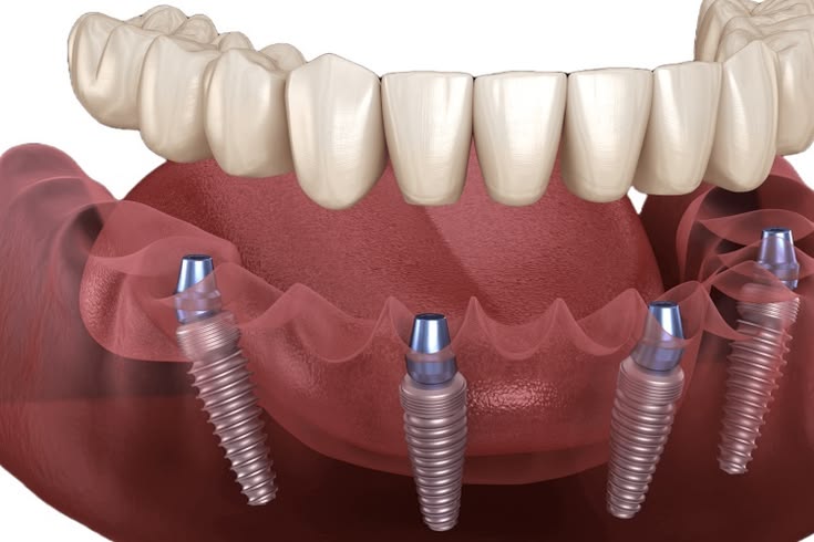 Kỹ thuật trồng răng Implant All-on-4