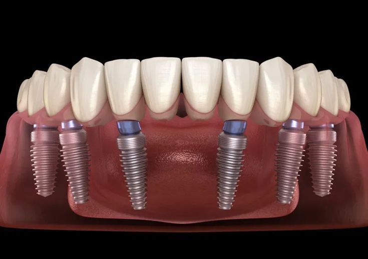 Kỹ thuật trồng răng Implant All-on-6