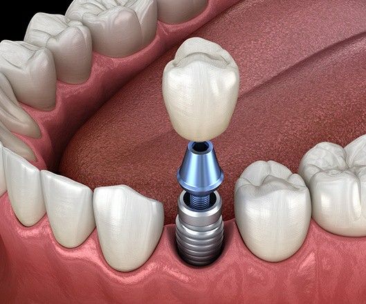 Trụ Implant đơn lẻ thay thế một răng mất