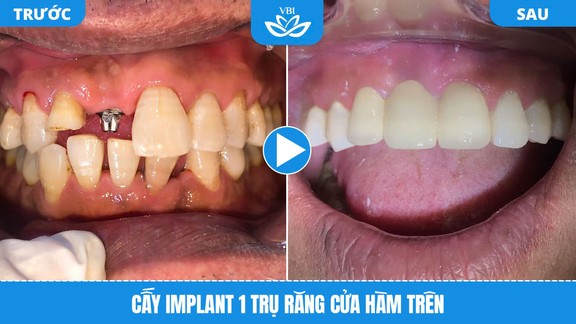 Cấy 1 trụ Implant răng cửa hàm trên - Hình ảnh trước và sau