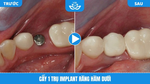 Phục hình tức thì với 1 trụ Implant răng hàm dưới - Hình ảnh trước và sau