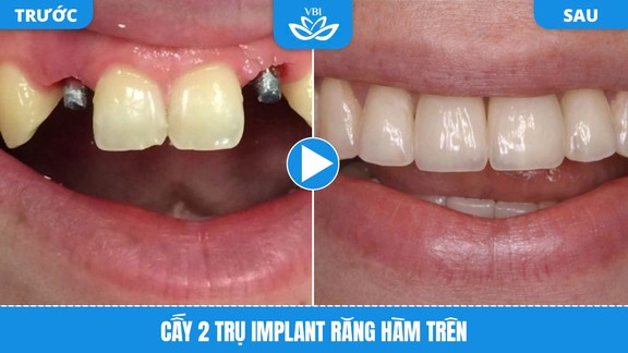 Cấy Implant vùng răng hàm trên - Hình ảnh trước và sau phục hình nhiều răng