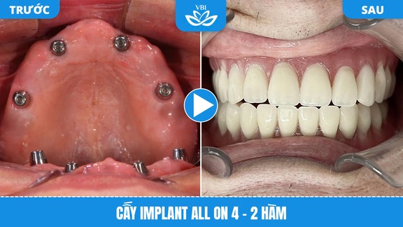 Cấy Implant All-on-4 hai hàm - Hình ảnh trước và sau phục hình toàn hàm