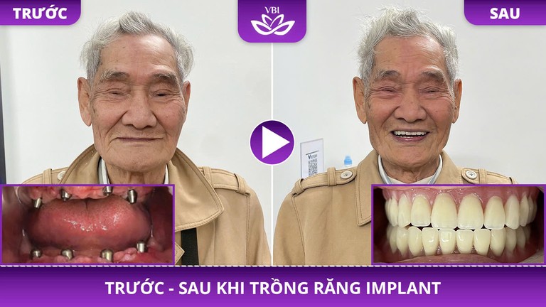 Trồng Implant cho trường hợp mất một vài răng