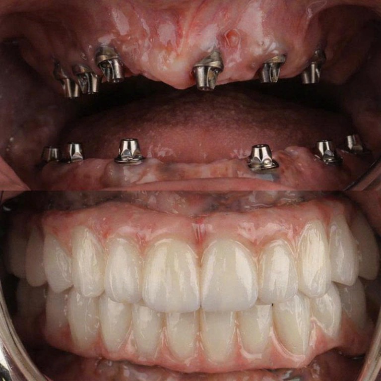 Trồng Implant toàn hàm All-on-4 All-on-6